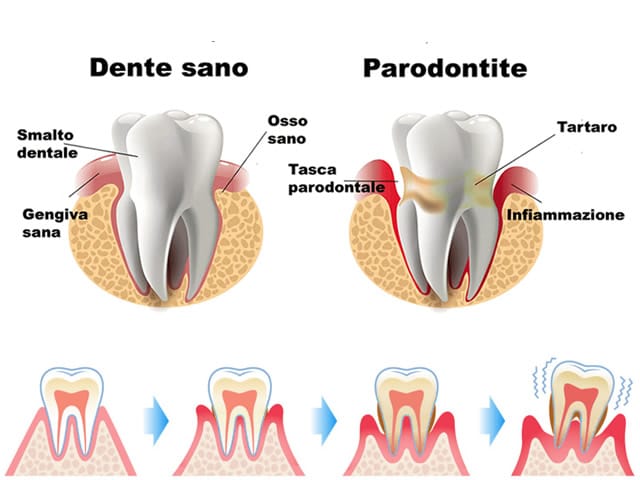 Terapia parodontale